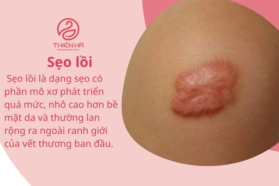 Hình ảnh vết sẹo lồi