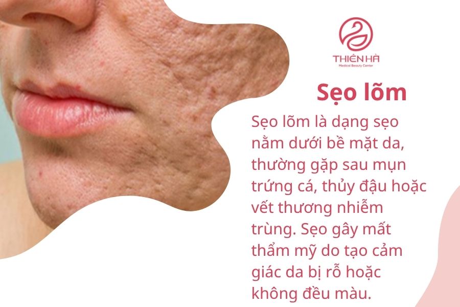 Hình ảnh sẹo lõm