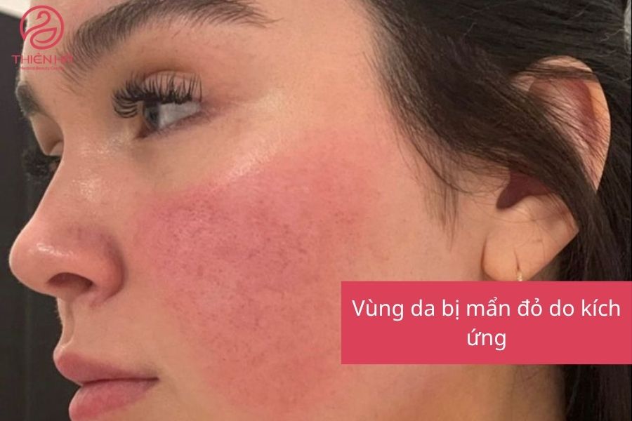 Vùng da bị mẩn đỏ do kích ứng