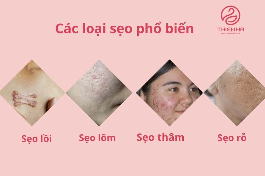 Các loại sẹo thường gặp
