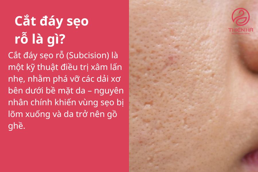 Cắt đáy sẹo rỗ là gì?