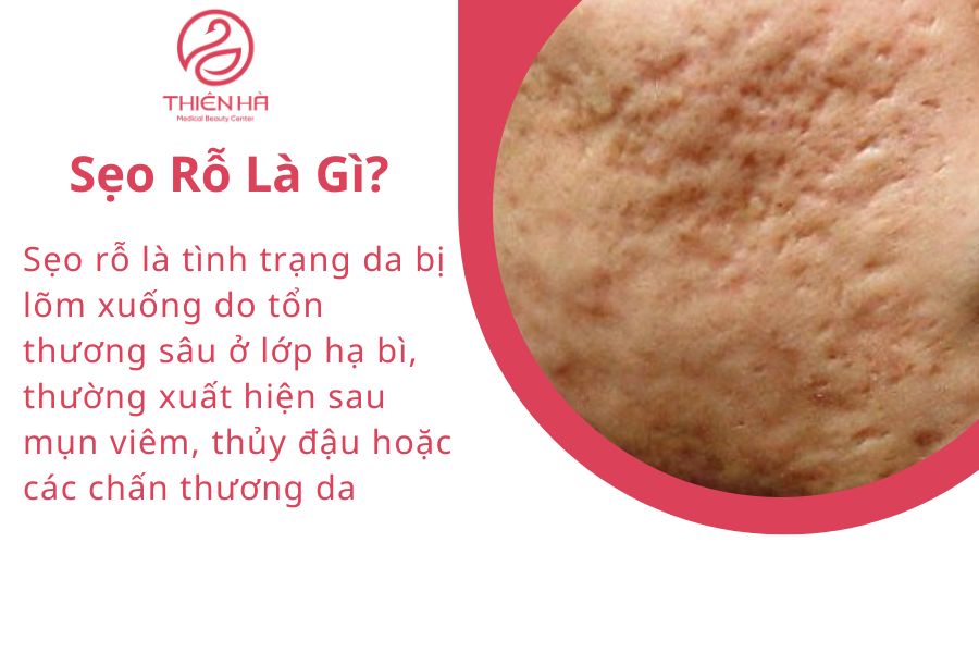 Khái niệm về sẹo rỗ