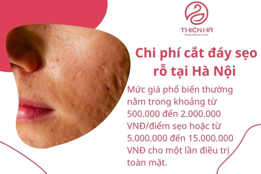 Chi phí cắt đáy sẹo rỗ tại Hà Nội
