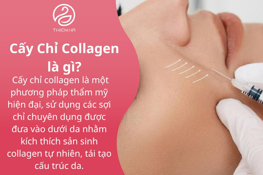 Cấy Chỉ Collagen là gì?