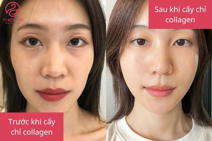 Kết quả cấy chỉ collagen