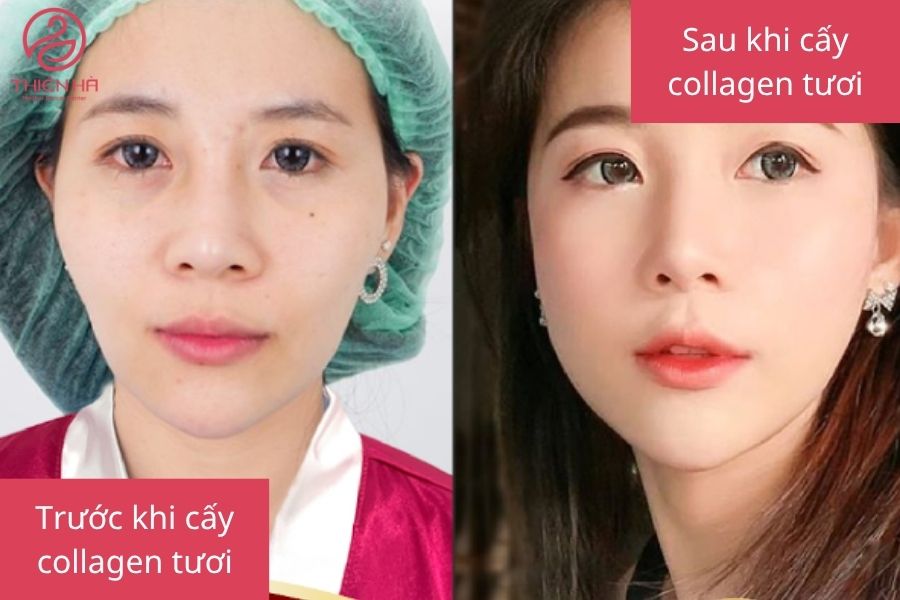 Hình ảnh cho thấy làn da săn chắc, giảm nếp nhăn sau liệu trình cấy collagen