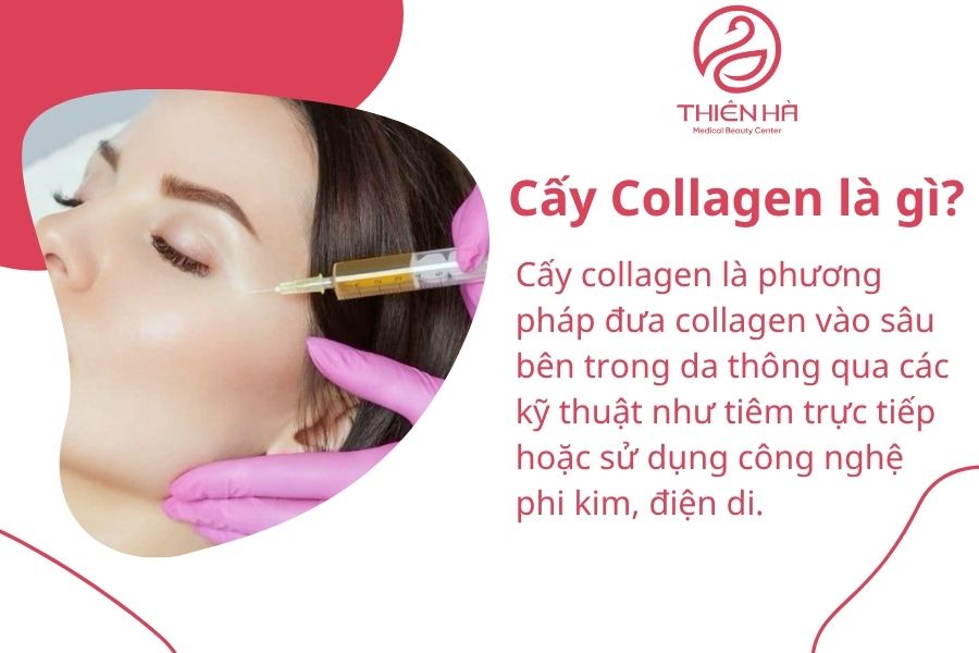 Cấy Collagen là gì?