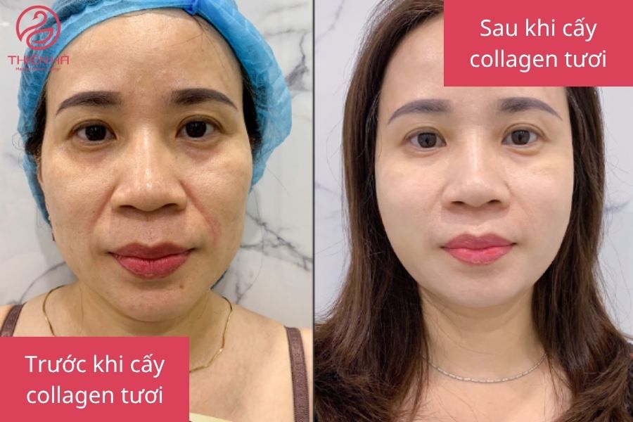 Hình ảnh so sánh tình trạng da trước và sau khi thực hiện liệu trình cấy collagen tươi.