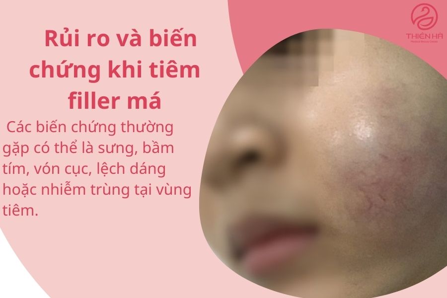 Biến chứng sưng má tại vùng tiêm filler 