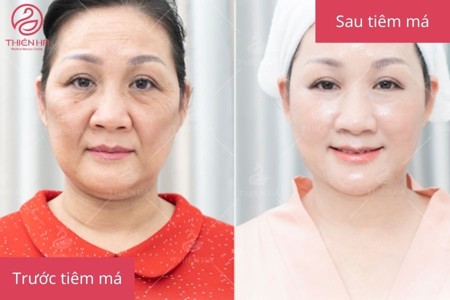 Kết quả tiêm filler má tại Viện thẩm mỹ Thiên Hà
