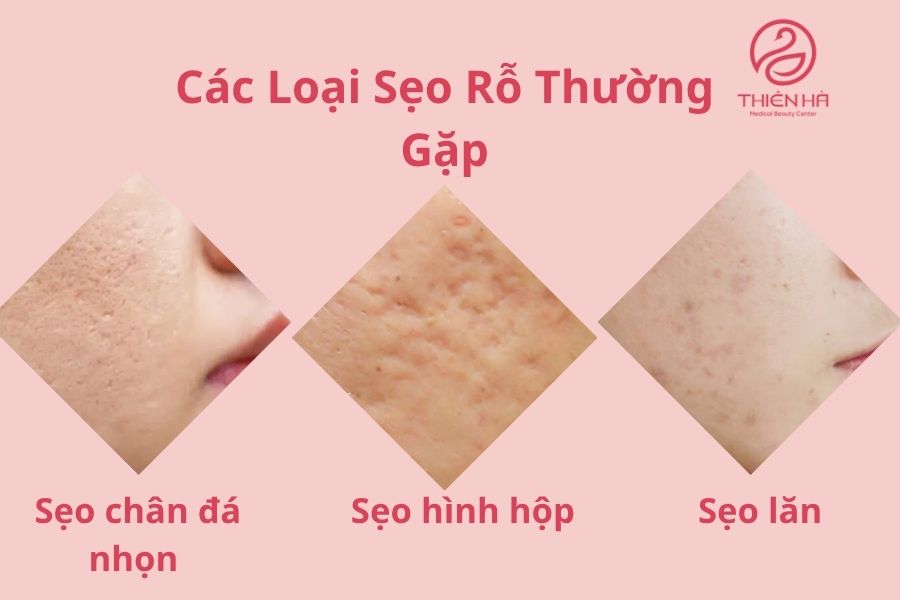 Các Loại Sẹo Rỗ Thường Gặp