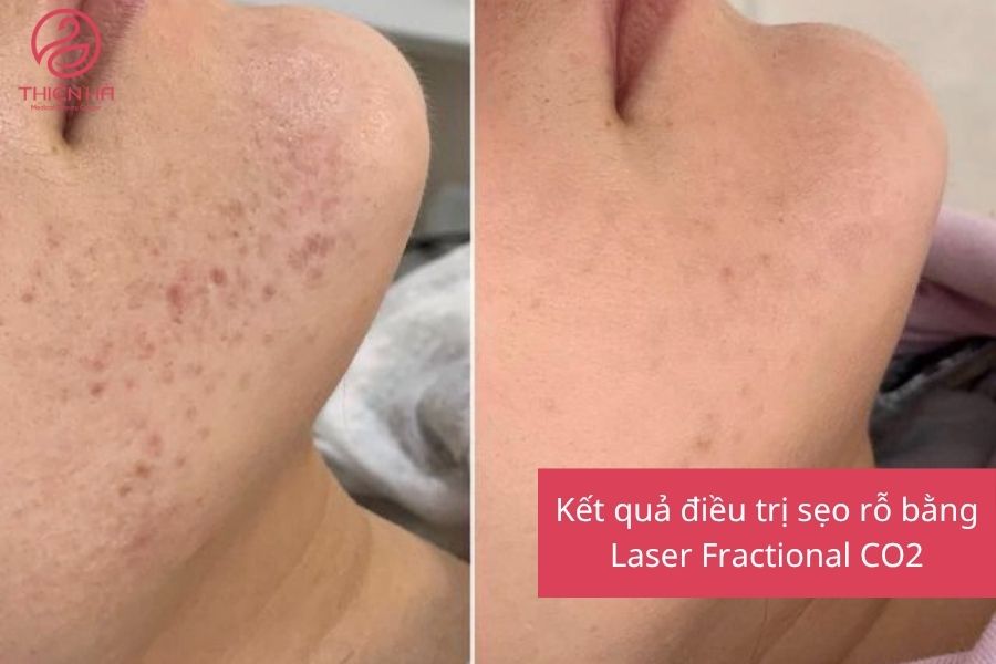 Kết quả điều trị sẹo rỗ bằng Laser Fractional CO2