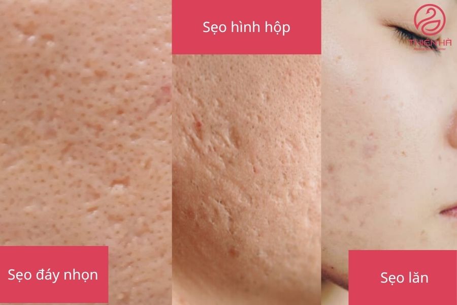 Các loại sẹo rỗ thường gặp