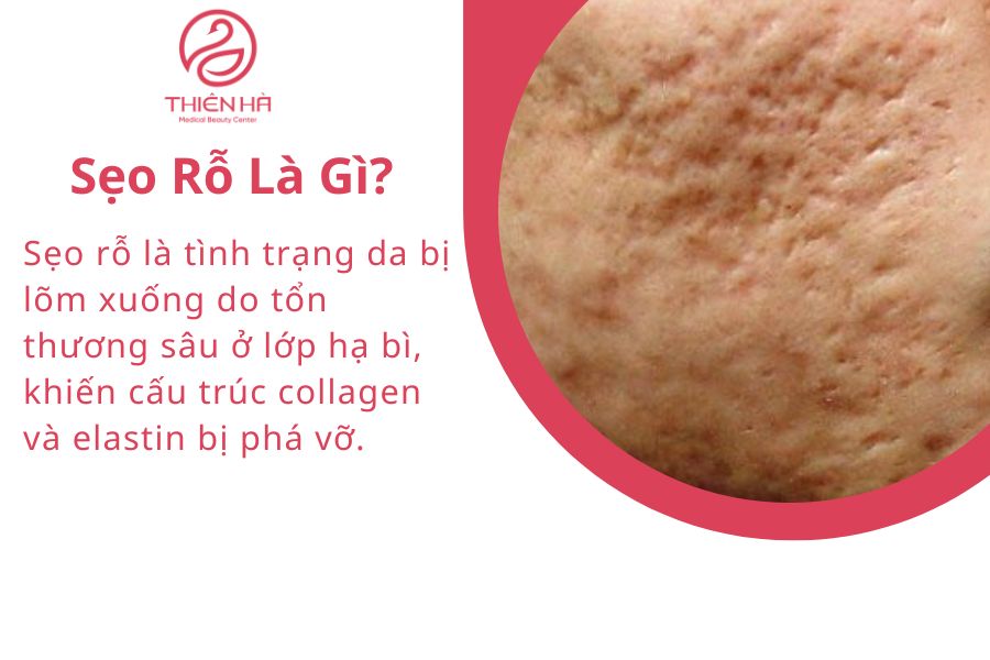 Sẹo Rỗ Là Gì?