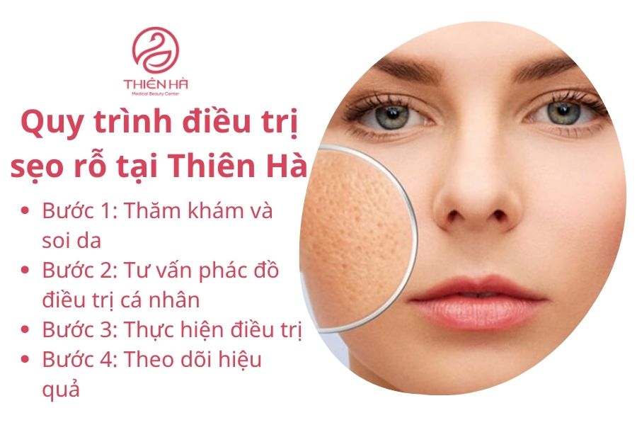 Các bước điều trị sẹo rỗ tại Thiên Hà