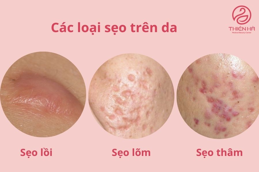 Các loại sẹo thường gặp 
