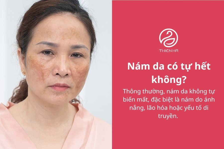 Câu hỏi thường gặp về nám da