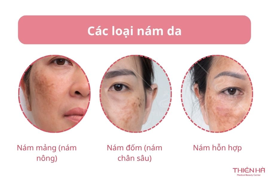 Các loại nám da 