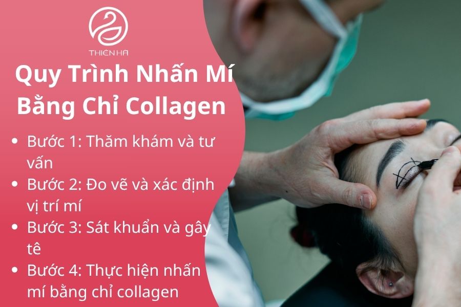 Các bước trong quy trình nhấn mí bằng chỉ collagen
