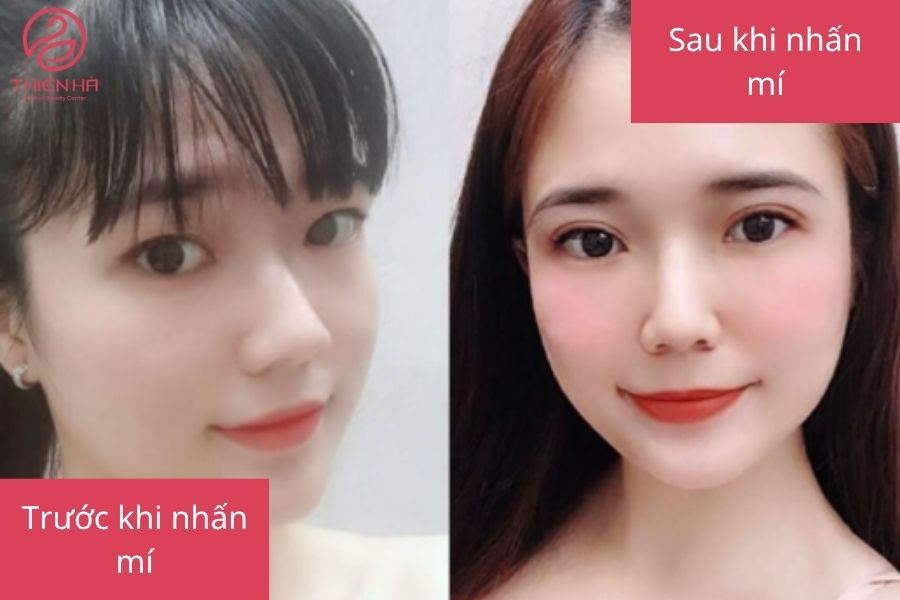 Hình ảnh trước và sau khi nhấn mí bằng chỉ collagen