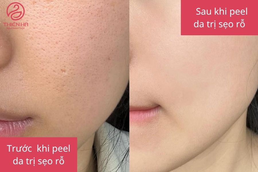 Kết quả peel da trị sẹo rỗ.
