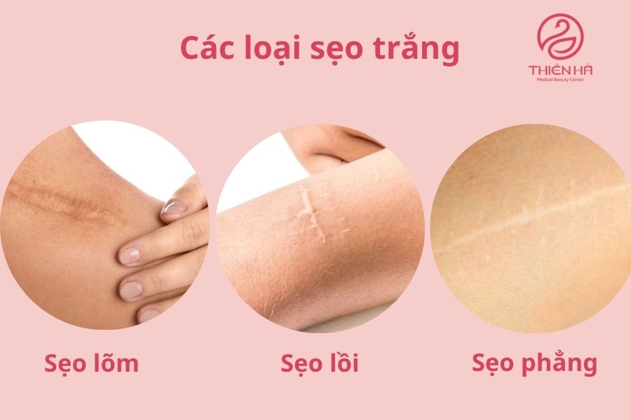 Các loại sẹo trắng thường gặp