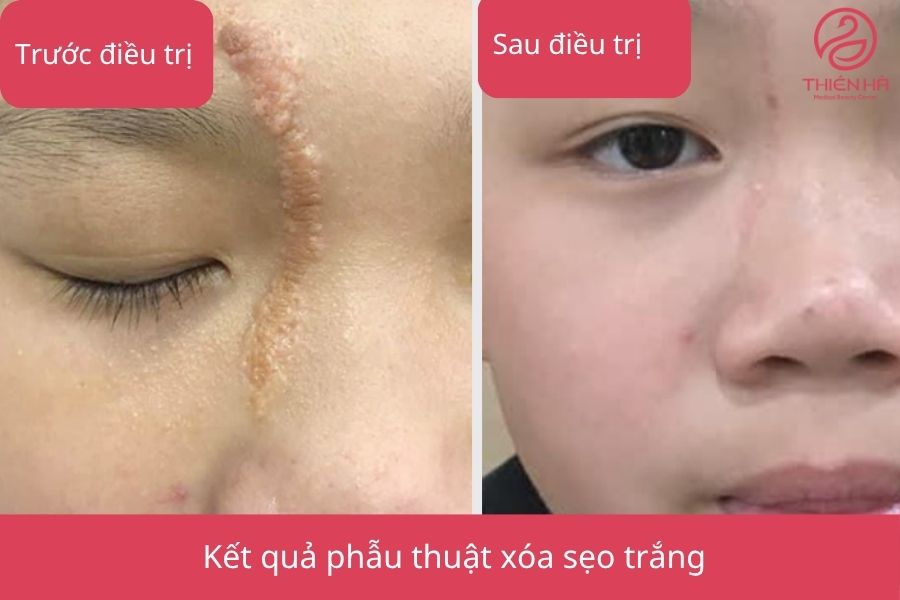 Kết quả phẫu thuật xóa sẹo trắng