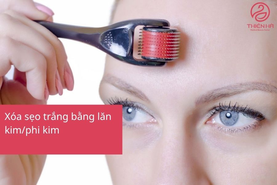 Xóa sẹo trắng bằng lăn kim