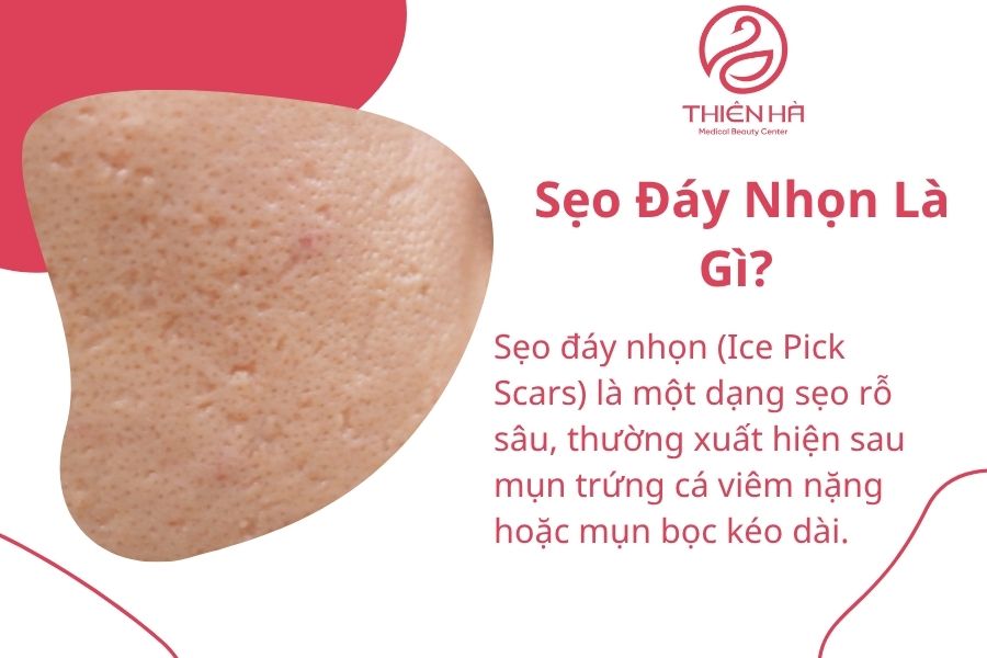Sẹo Đáy Nhọn Là Gì?