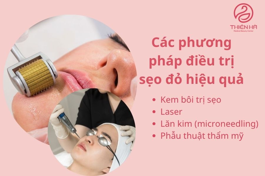 Các phương pháp điều trị sẹo đỏ (laser, lăn kim...)