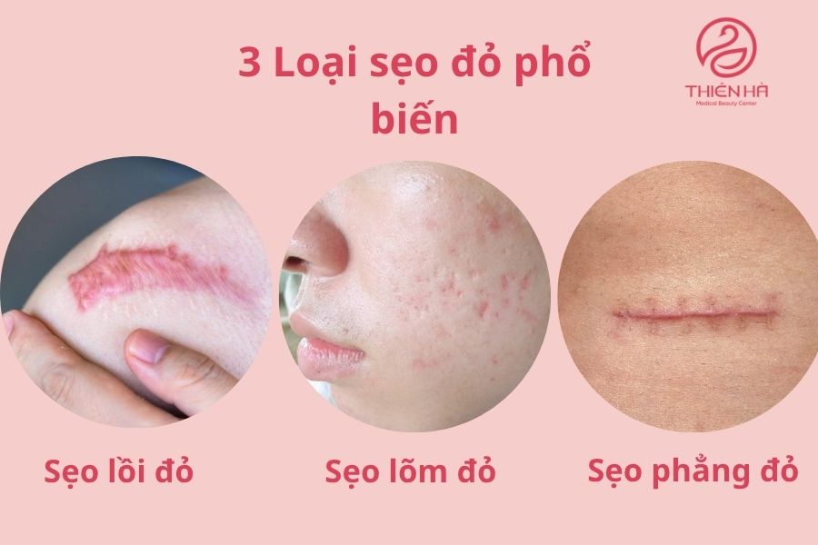 Các loại sẹo đỏ thường gặp