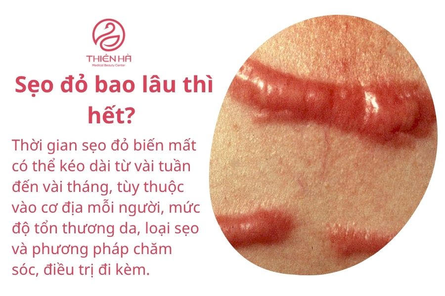 Sẹo đỏ bao lâu thì hết?