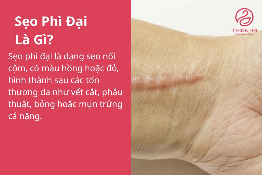 Sẹo Phì Đại Là Gì?