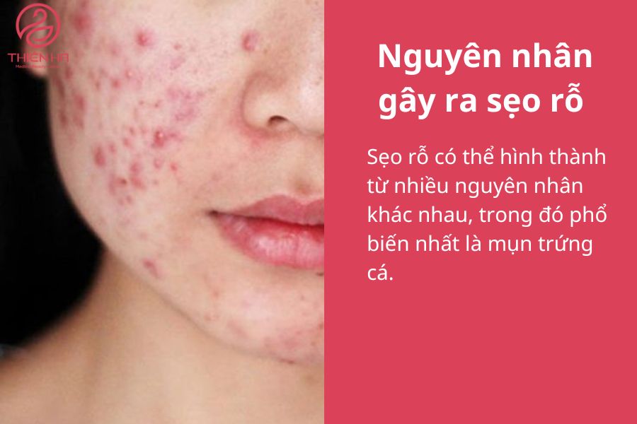 Nguyên nhân gây ra sẹo rỗ