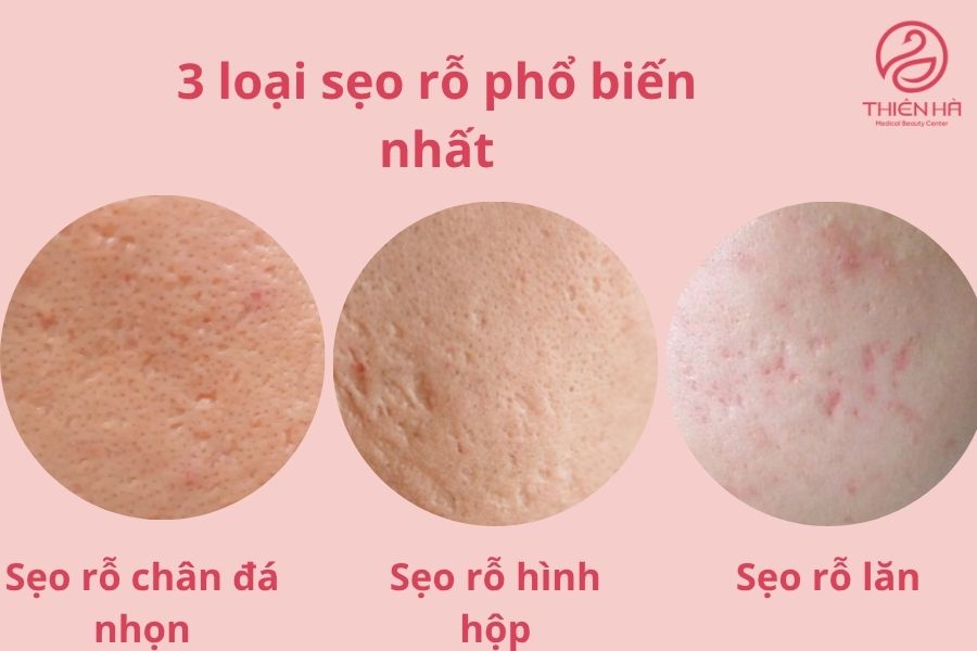 Phân loại sẹo rỗ