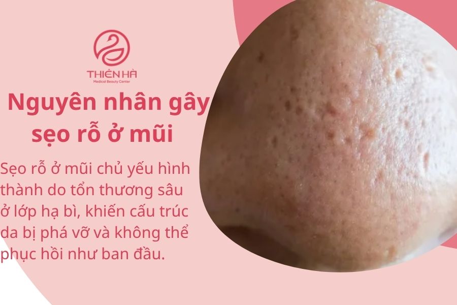 Nguyên nhân gây ra sẹo rỗ ở mũi 