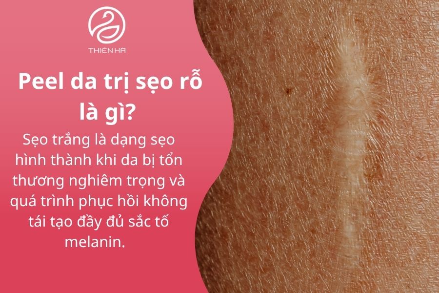 Sẹo trắng là gì?