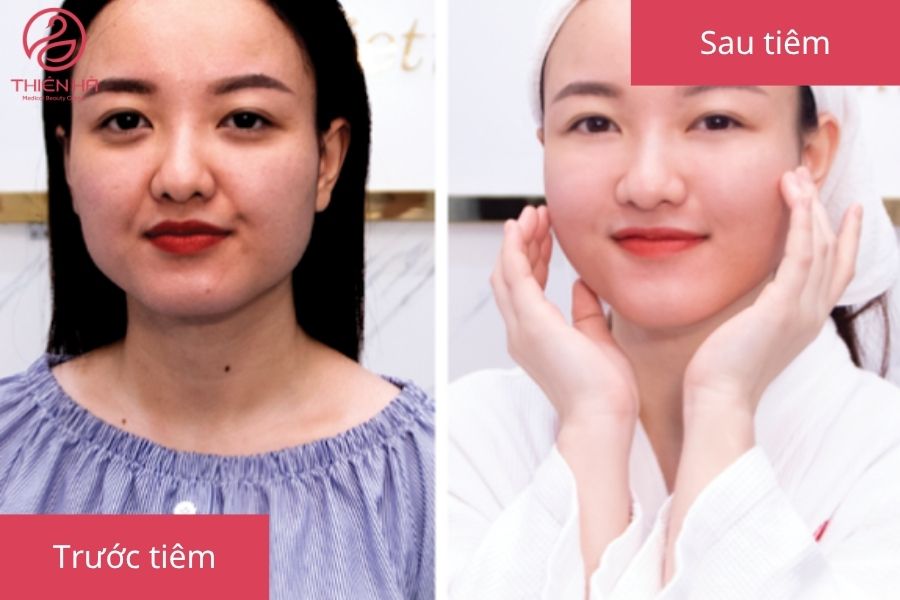 Hình ảnh so sánh trước và sau khi tiêm filler mặt, cho thấy sự khác biệt rõ rệt