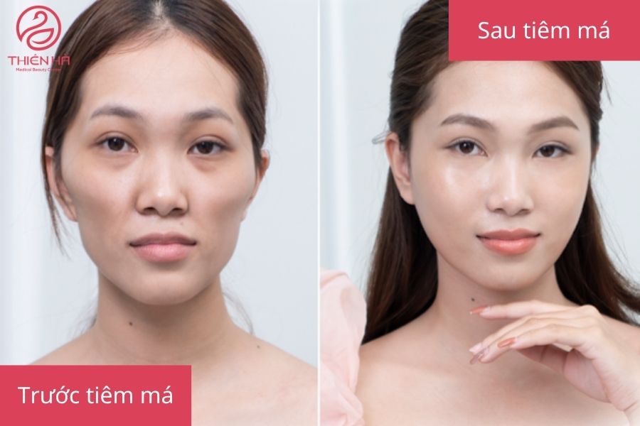 Sự khác biệt rõ rệt sau khi tiêm filler má baby