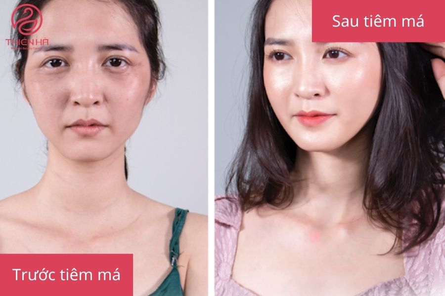 Hình ảnh trước và sau khi tiêm filler má, cho thấy sự thay đổi rõ rệt về độ đầy đặn của vùng má