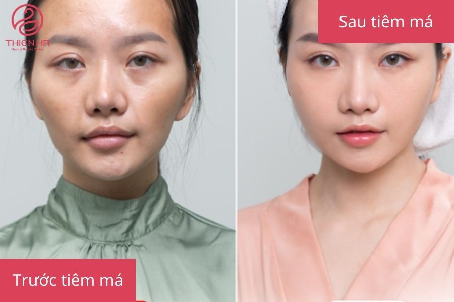 Hình ảnh khách hàng trước và sau khi tiêm filler má tại TMV Thiên Hà