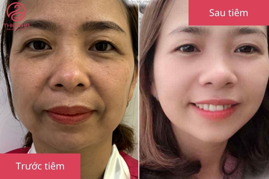 Kết quả tiêm filler mắt tại Viện Thẩm Mỹ Thiên Hà