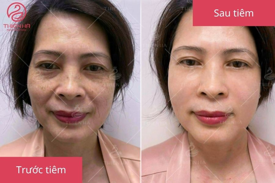 Kết quả tiêm filler rãnh cười tại TMV Thiên Hà