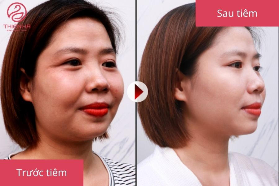 Hình ảnh khách hàng trước và sau khi tiêm filler thái dương tại TMV Thiên Hà