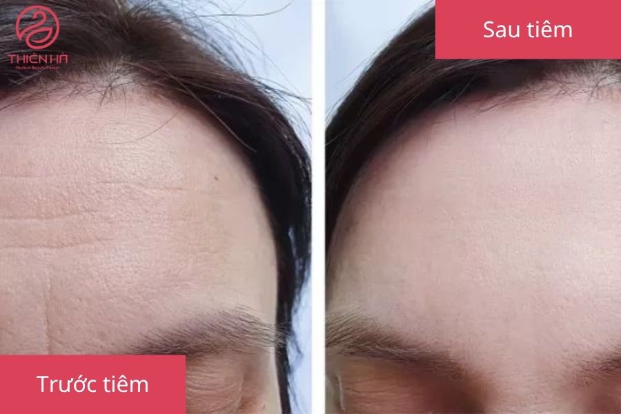 Hình ảnh trước và sau khi tiêm filler trán tại Viện Thẩm Mỹ Thiên Hà