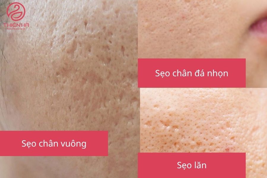 Các Loại Sẹo Rỗ 