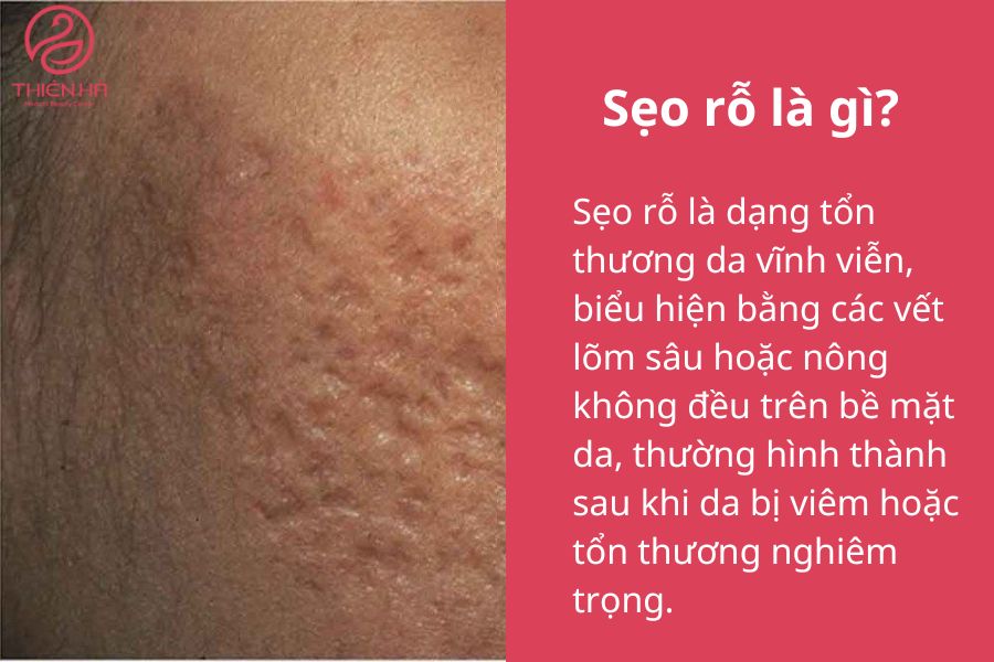 Sẹo rỗ là gì? 