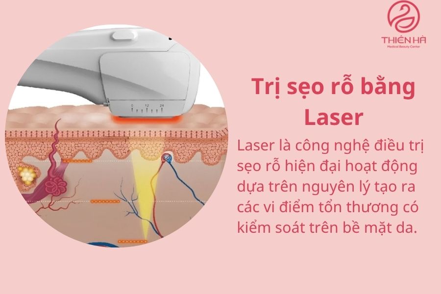 Trị sẹo rỗ bằng Laser