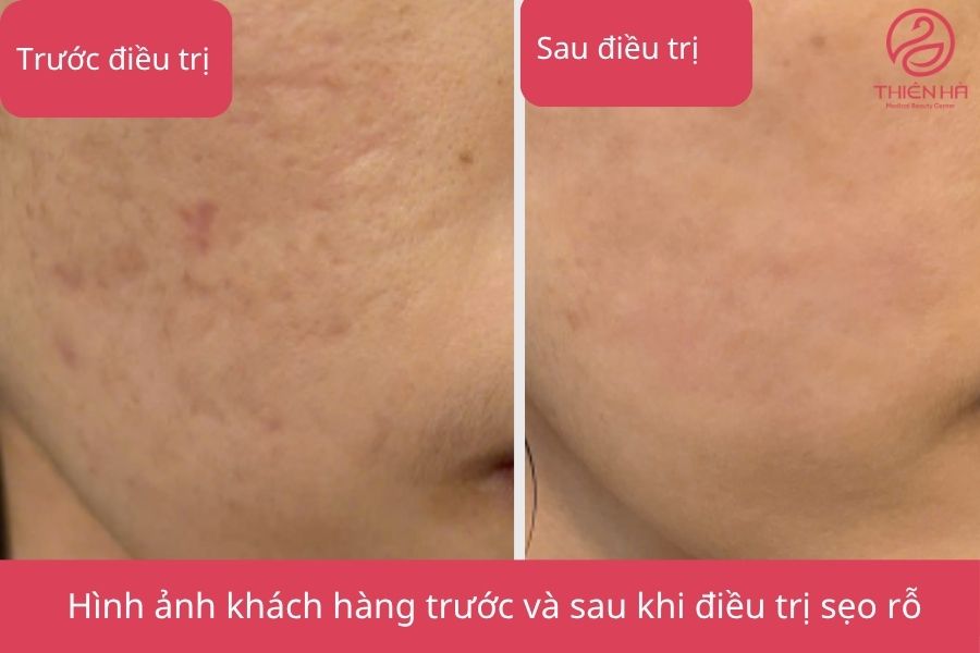 Kết quả trị sẹo rỗ bằng laser tại TMV Thiên Hà
