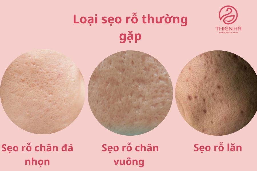 Các loại sẹo rỗ thường gặp